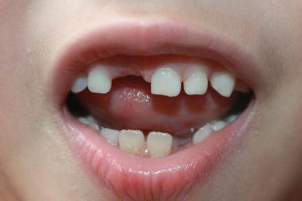 梦到掉牙齿是什么预兆男人 梦到掉牙齿是什么预兆男人