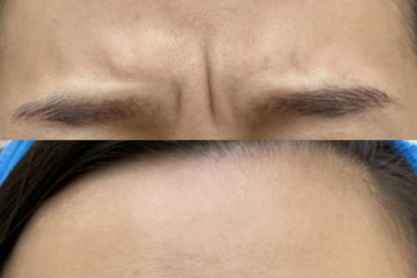 眉间八字纹,眉间两道竖纹代表什么 眉间八字纹,眉间两道竖纹代表什么