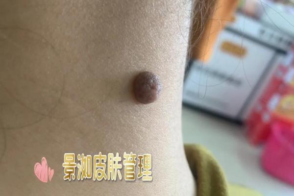 风水上女生脖子后面有痣代表什么啊 风水上女生脖子后面有痣代表什么啊