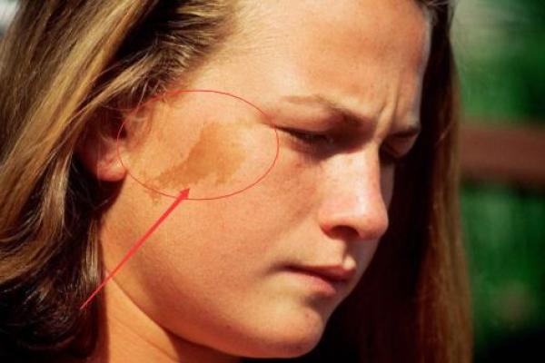 红胎记算命可不可靠 红胎记算命可不可靠