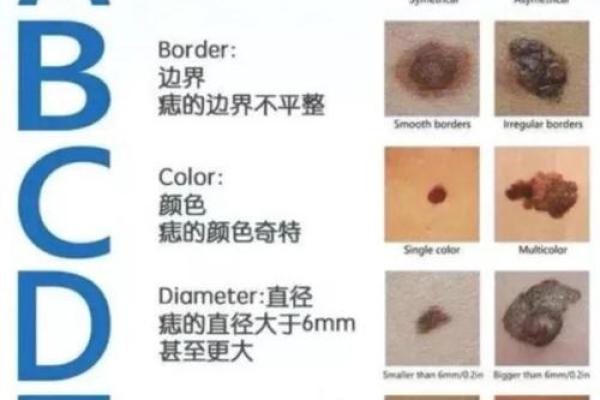 身体上的胎记位置不同算命分析 身体上的胎记位置不同算命分析