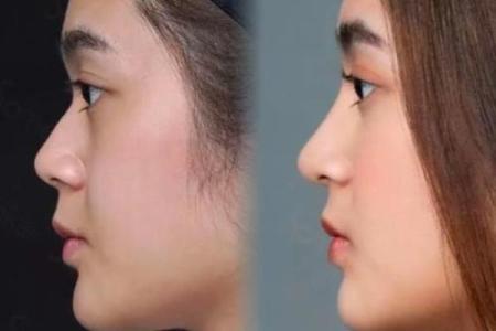 低鼻梁怎么办