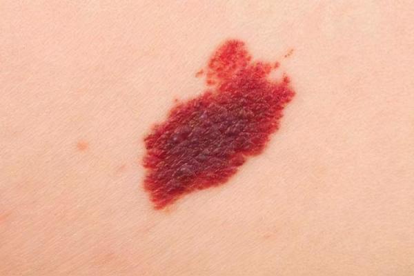 红色胎记算命图解