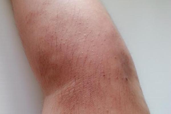 手臂胎记算命 手臂胎记算命