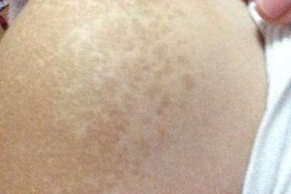 手臂胎记算命 手臂胎记算命