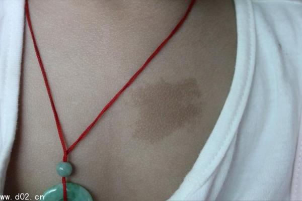 胎记算命的位置与命运 胎记算命的位置与命运