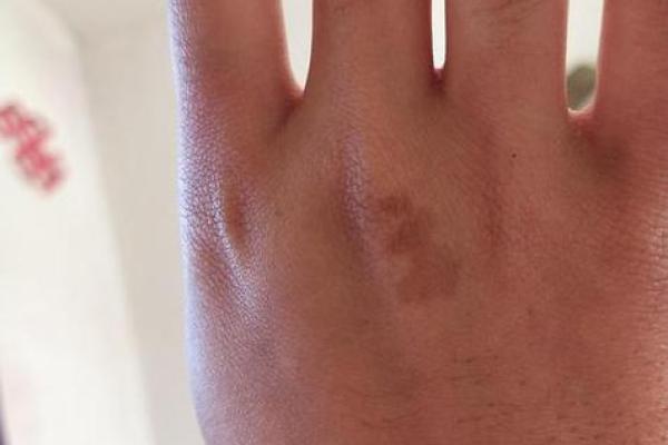 胎记算命图,后背胎记全面图解 胎记算命图,后背胎记全面图解