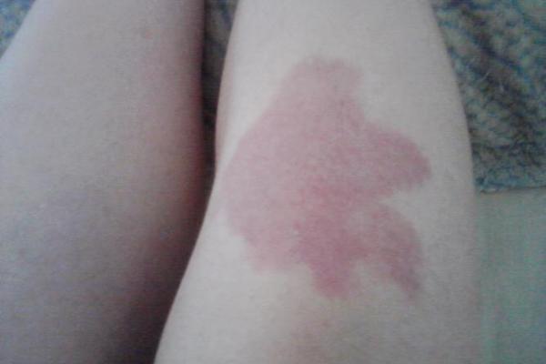 胎记算命图,后背胎记全面图解 胎记算命图,后背胎记全面图解