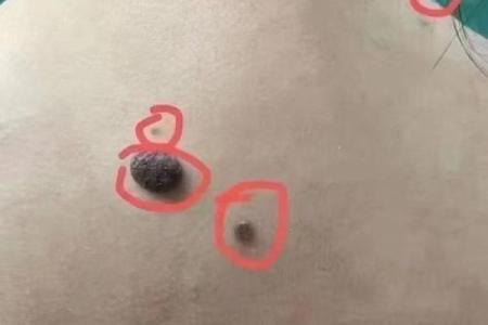 女人背部痣相图解算命