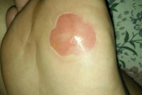 算命脚底破了 算命脚底破了