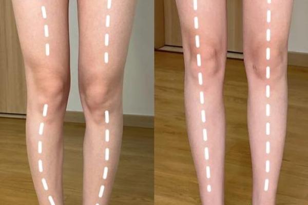 八字型腿 八字型腿