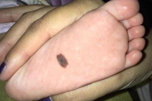 看胎记位置算命