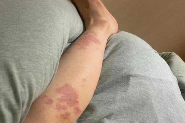 腿上不同位置的胎记算命 腿上不同位置的胎记算命