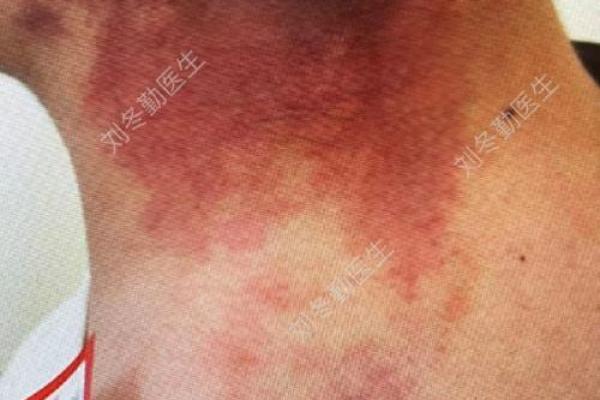 脖子上的胎记如何算命-