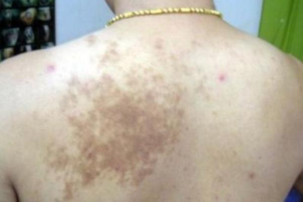 脖子上的胎记如何算命-