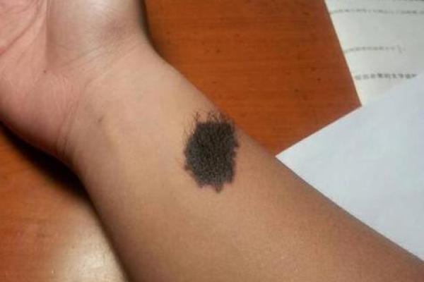 胎记算命：如何看胎记算命