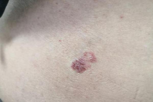 屁股有白斑风水 屁股有白斑风水