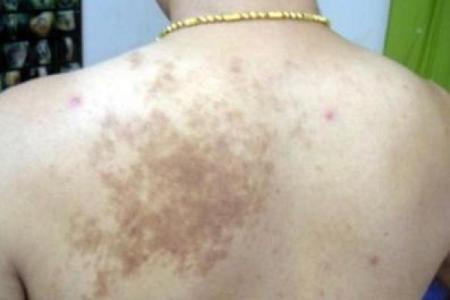 腿上胎记算命分析