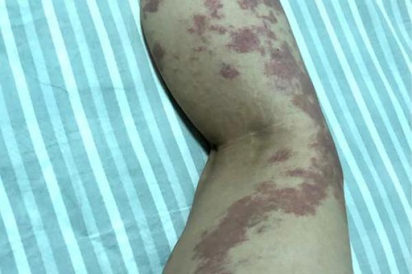 背部胎记算命,背部有胎记会怎样 背部胎记算命,背部有胎记会怎样