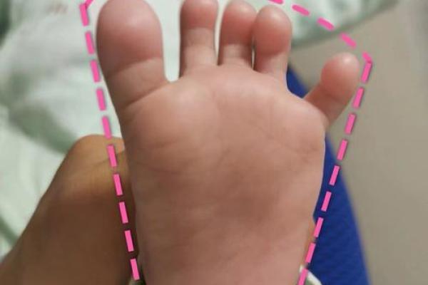 2岁八字脚 2岁八字脚