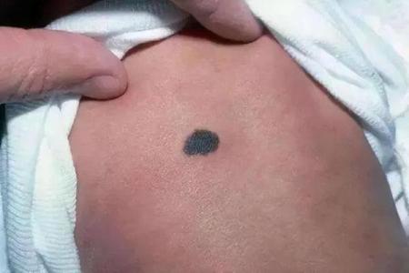背部胎记算命，背部有胎记会怎样