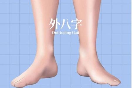 小孩外八字腿