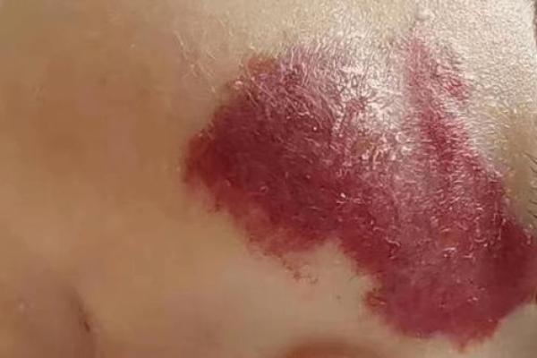 红色胎记算命 红色胎记算命