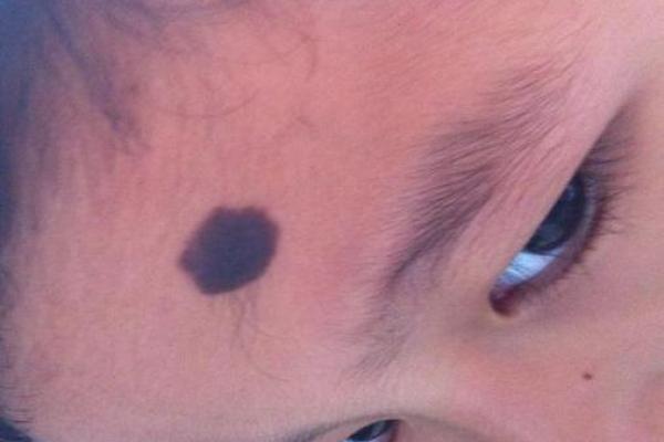 胎记算命：从胎记看运势