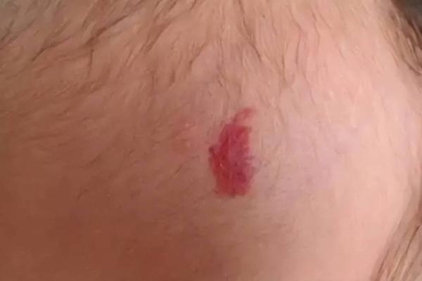 胎记算命：从胎记看运势