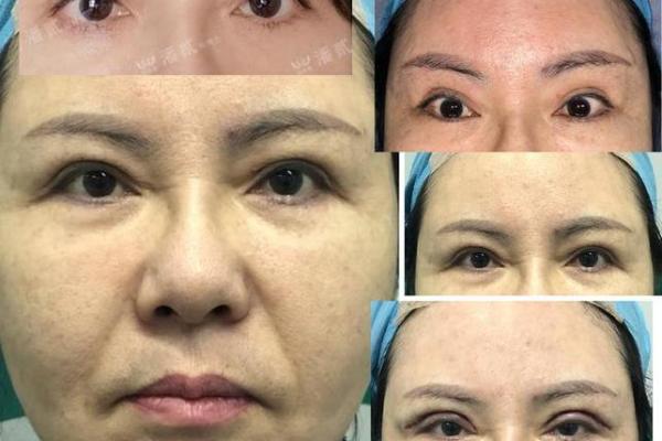 割双眼皮忌讳什么风水