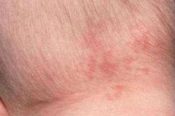 胎记算命:怎么看胎记 胎记算命:怎么看胎记