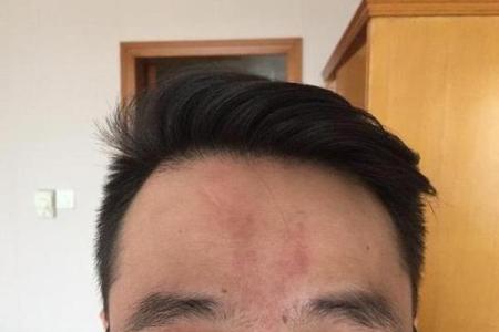 印堂八字纹的男人面相婚姻