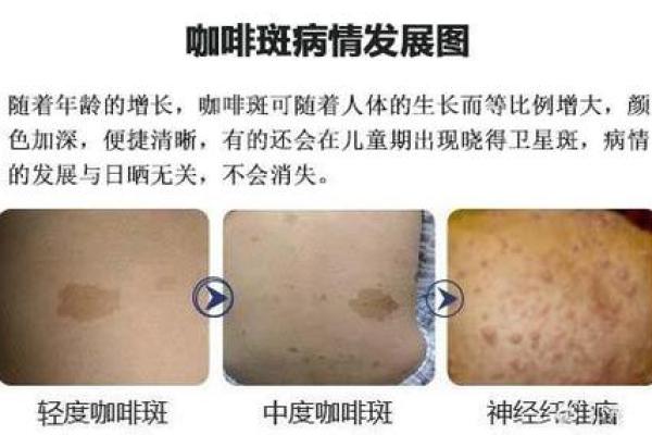 详解胎记算命 详解胎记算命