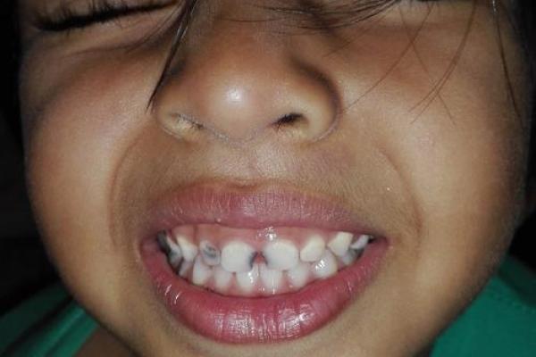 八字牙齿 八字牙齿