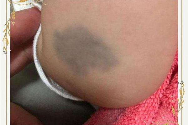 看胎记颜色类型算命