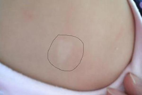 胎记算命全解 胎记算命全解