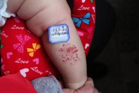 手指内侧长红胎记算命准吗