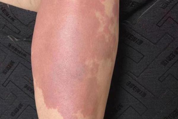 大腿上胎记的位置与算命