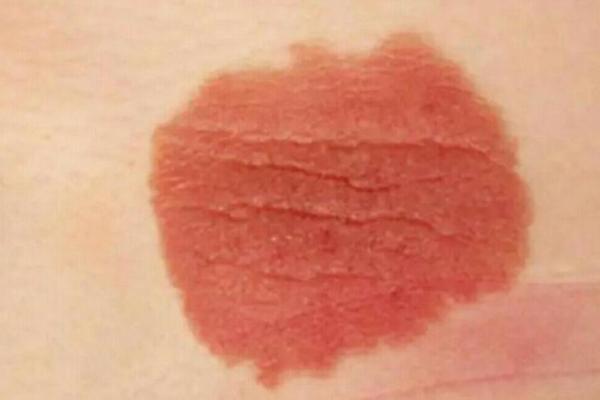 红色胎记算命分析