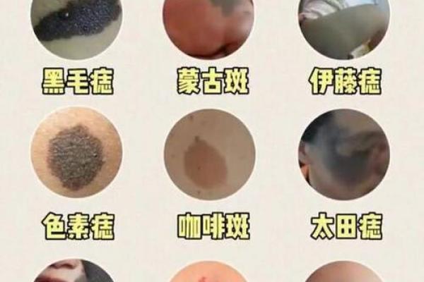 看脸上胎记如何算命