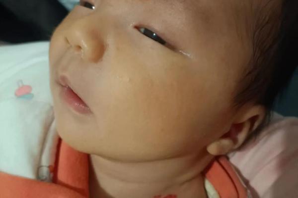 怎么看胎记算命-