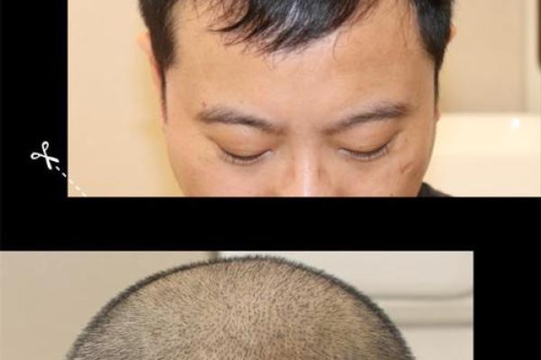 头发稀少的八字特征 八字头发稀少